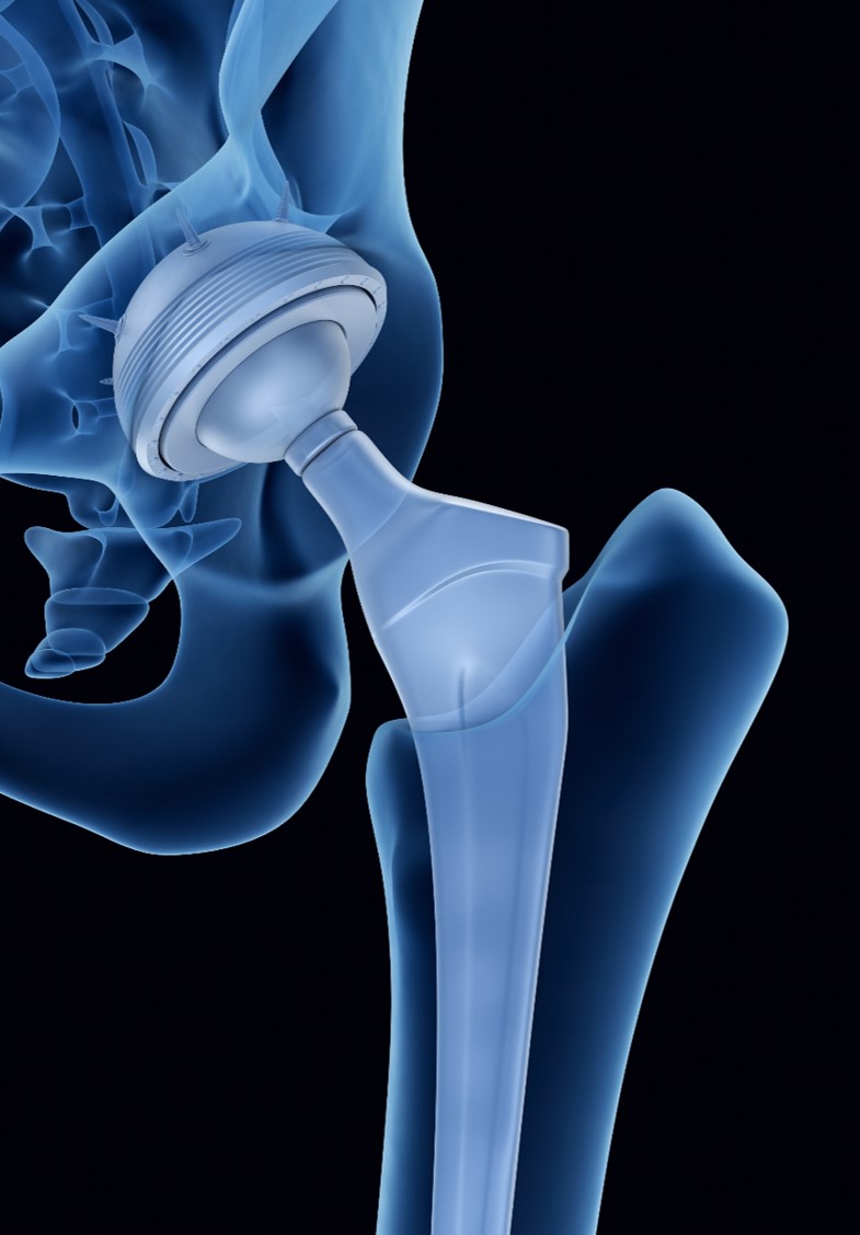 Hip replacement X-ray