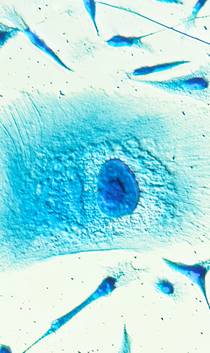  Prostate cancer cells stained blue 